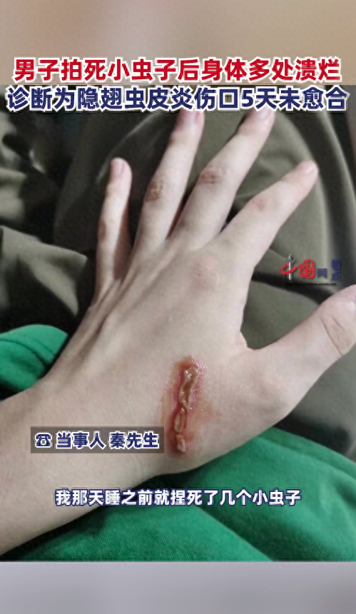 家里出现隐翅虫怎么消灭（宝鸡一男子拍死隐翅虫，致身上多处溃烂肿痛，遇到隐翅虫怎么办）(图1)