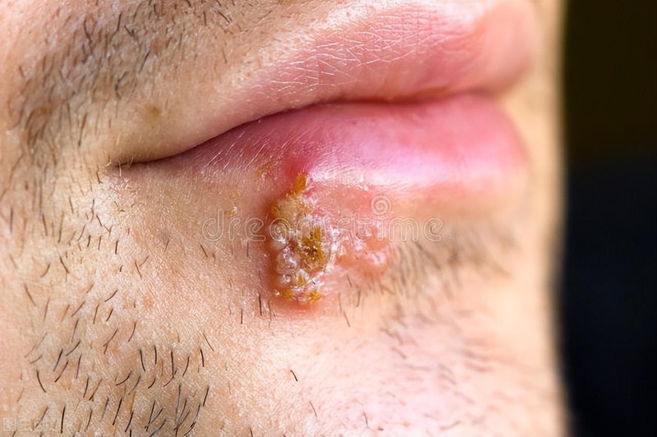 水泡和疱疹的区别图片（嘴上长水泡，它是口腔溃疡还是唇疱疹，你如何摆脱它？挑破水泡）(图2)